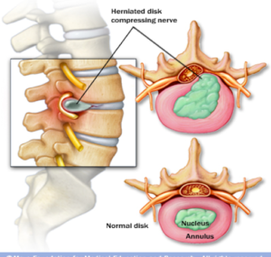 How to Heal a Bulging Disc Naturally - Spinal Backrack