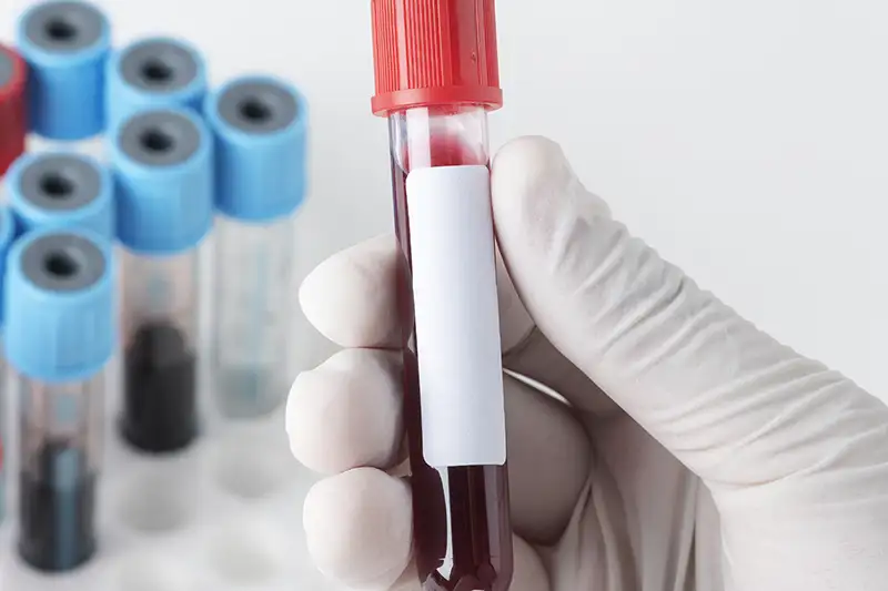 surgeon-holding-a-coronavirus-blood-test-tube